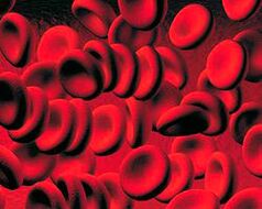 Accumulation of ketone body in the blood in diabetes